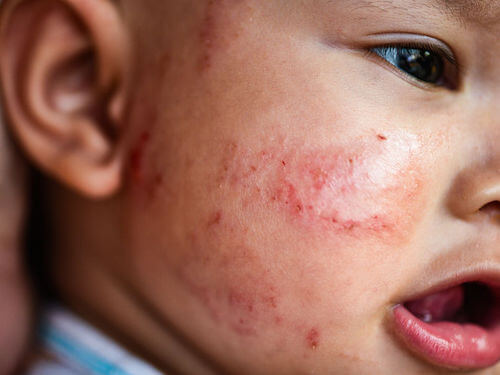 Baby with acne on their face