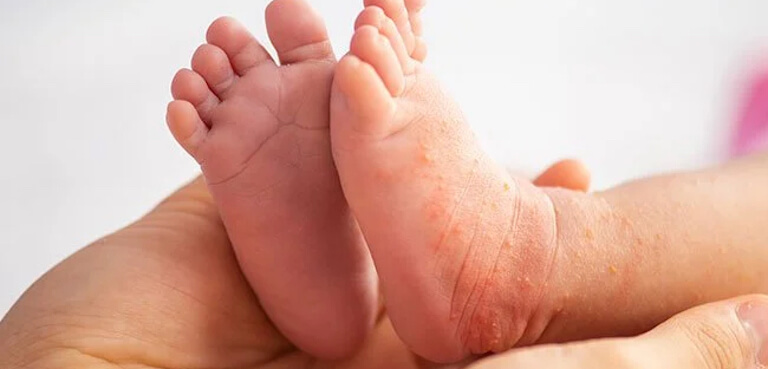 Rash on baby feet