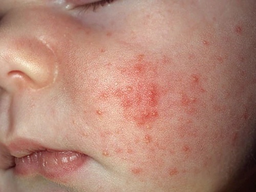 Newborn baby with acne on their cheeks