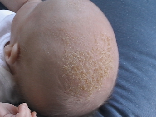 Newborn baby with cradle cap on their head